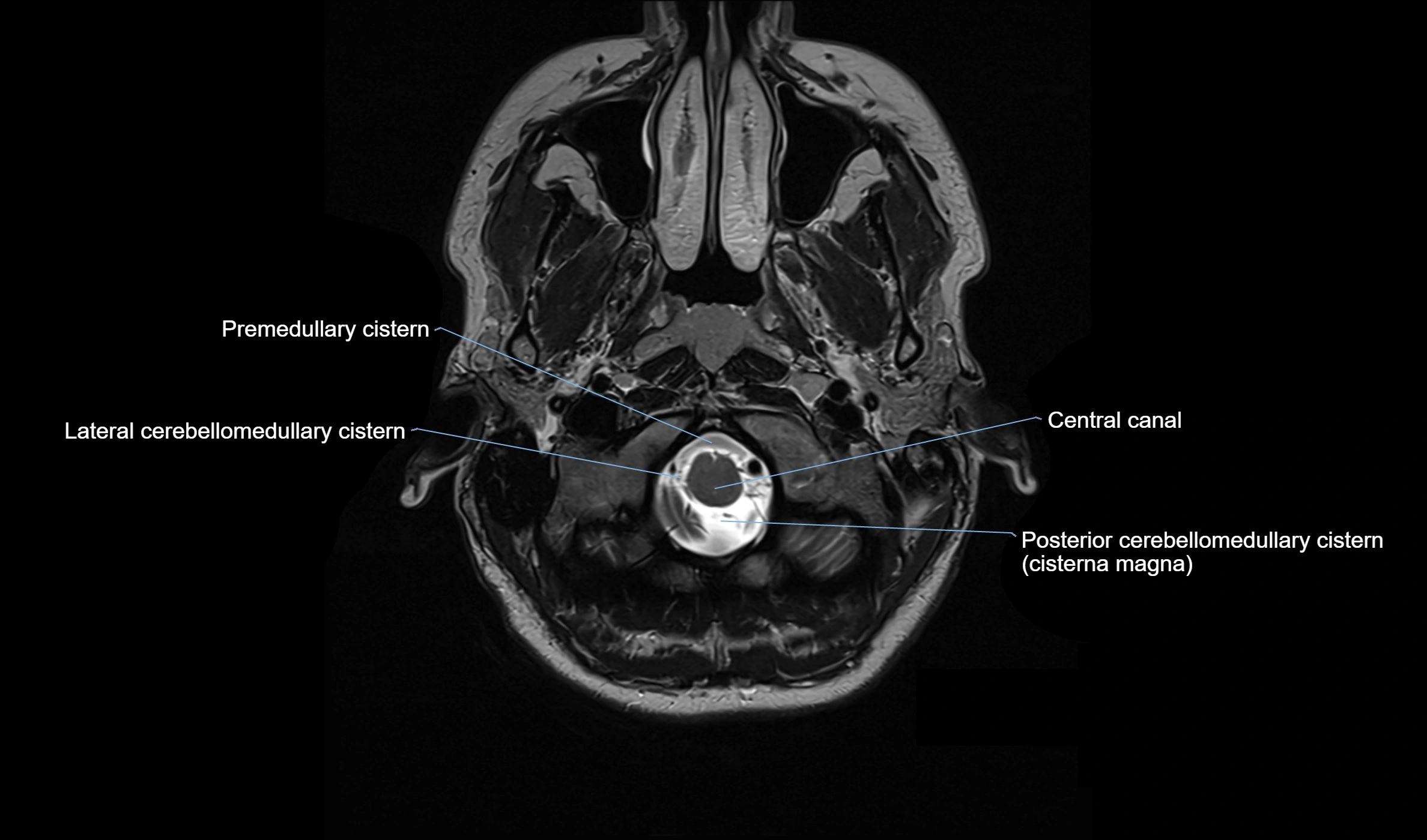 Brain cisterns  and ventricles  axial anatomy 3T MRI image-img-00001-00002.webp